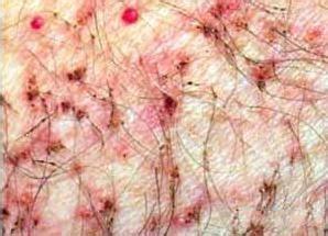 阴虱的中医治疗方法 阴虱的中医治疗方法 阴虱的中医治疗