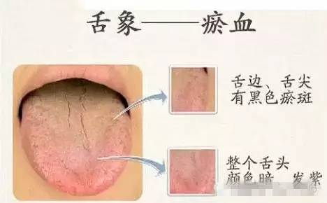 舌头上火溃疡怎么办 舌头上火怎么办 老中医推荐几种去火方