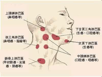 淋巴结肿大怎么消除 淋巴结肿大怎么办