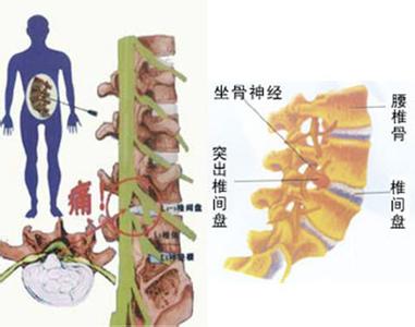 怎样治疗颈椎病最有效 毫不夸张，这个方法治疗腰椎间盘颈椎病太有效了，男女老少都适用