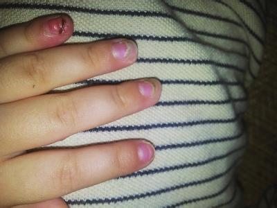 手指甲容易断裂 指甲容易断裂多数是缺乏维生素A