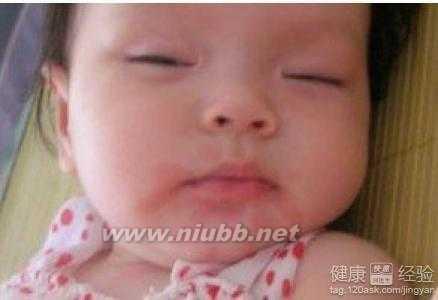 儿童脸部过敏用什么药 儿童脸部过敏用什么药 儿童脸部过敏的表现