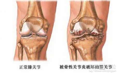 膝关节炎有哪些症状 膝关节炎症状不可忽略