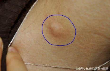 乳腺癌的早期信号 乳腺癌早期的信号