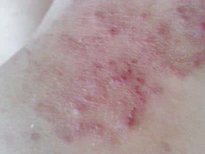 湿疹与皮肤癣的别 湿疹与皮肤癣的别 专家教你巧辨冬季湿疹、皮癣、皮肤瘙痒症