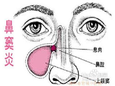 过敏性鼻炎食疗方法 鼻炎治疗不及时会病变 四种食疗方法可根治