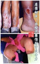 血栓闭塞性脉管炎 图文:血栓闭塞性脉管炎津门圣方