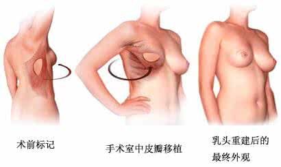 健康之路乳房再造手术 揭秘乳房颜色里的5个健康密码