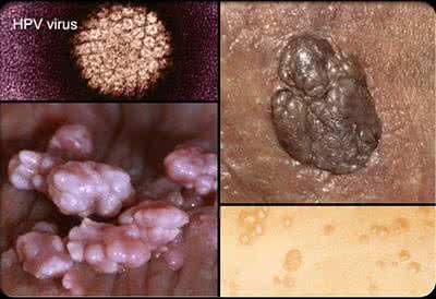 hpv病毒感染的症状 hpv病毒是什么?hpv病毒有什么症状?hpv病毒如何感染的?