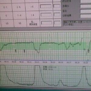胎心监护的时间多久 胎心监护的时间