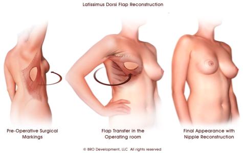 单侧乳房切除文胸选择 乳房分几型 你对文胸有多了解