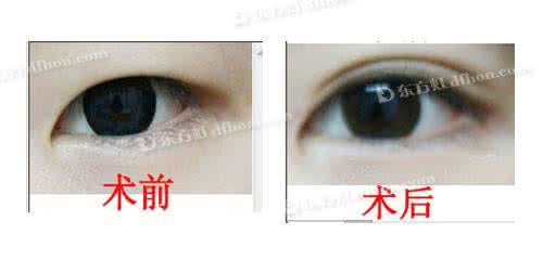 小眼畸形 小眼畸形图片 小眼畸形