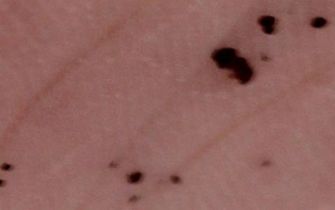 非黑色素瘤皮肤癌 非黑色素瘤皮肤癌在美国是常见疾病并非绝症