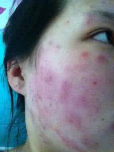 脸过敏发痒发红怎么治 脸上过敏发红发痒怎么办 过敏要注意保洁