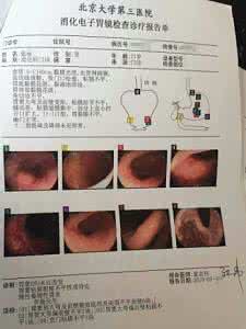 胃癌能不能治愈 胃癌早期怎么治疗 早期胃癌能不能完全治好