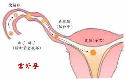 宫外孕的早期症状 症状:宫外孕的症状概述