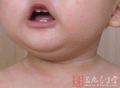 怎么预防宝宝长痱子 怎样预防宝宝长痱子 痱子怎么治疗
