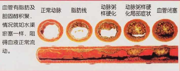 大蒜泡酒能畅通血管吗 5分鐘讓堵塞血管瞬間暢通！轉載一次救人一命