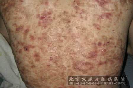 去鸡皮肤鸡皮疙瘩 鸡皮肤疙瘩毛囊炎 鸡皮肤知多少 常起“鸡皮疙瘩”该怎么办