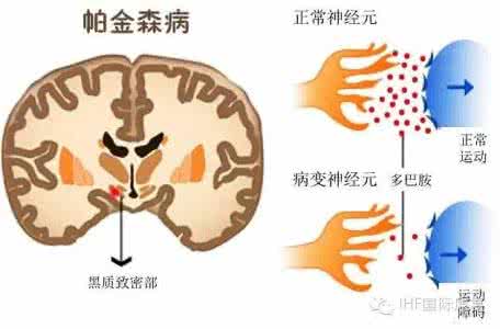 全国帕金森医院排名 世界帕金森病日：你可能误解的帕金森病