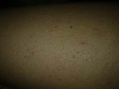 艾滋病患者症状 艾滋病的症状 女性艾滋病患者的常见症状