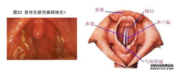 喉咙异物感打嗝食道癌 食道喉咙异物感嗓子堵 嗓子感觉有异物 喉咙异物感是怎么回事