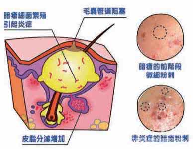 下巴长暗疮是什么原因 暗疮是什么 暗疮是怎么来的