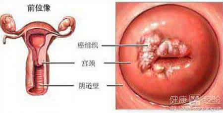 宫颈癌晚期死前症状 宫颈癌晚期能活多久 宫颈癌有哪些症状
