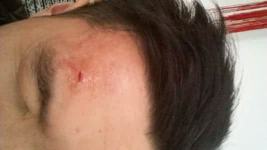 额头上有黑色死皮疤 额头磕破了会留疤吗？