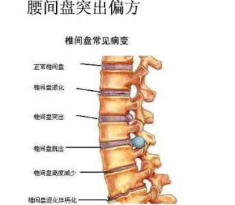 根治腰间盘突出的偏方 腰间盘突出治疗偏方 偏方治腰椎突出的要点