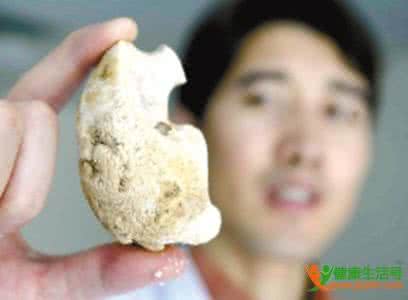肾结石症状有哪些 肾结石的7大症状 看看你有无