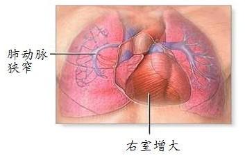 肺栓塞 肺动脉高压 肺栓塞 肺动脉高压 平调气血、痰瘀同治法治疗慢性肺血栓栓塞性肺动脉高压的