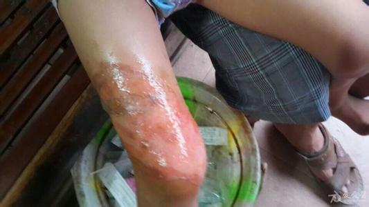 止嗽立效丸的副作用 烫伤的立效治疗法