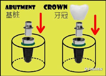 种植牙注意事项 种植牙注意事项 脐橙价格以及脐橙树的种植注意事项