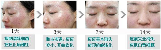 中医治疗青春痘的方法 中医治疗青春痘方法 中医治疗青春痘的方法你造吗