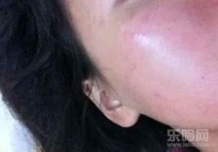 酒精过敏的症状图片 酒精过敏症状图片 酒精过敏症状