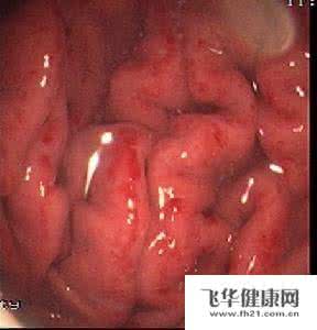糜烂性胃炎的症状 糜烂性胃炎症状 糜烂性胃炎的症状有哪些?