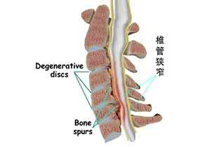 腰椎管狭窄是什么原因 腰椎管狭窄 腰椎管狭窄是什么导致的