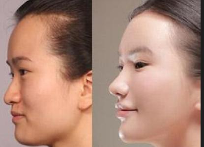 假体隆鼻的危害 隆鼻的害处 隆鼻的危害