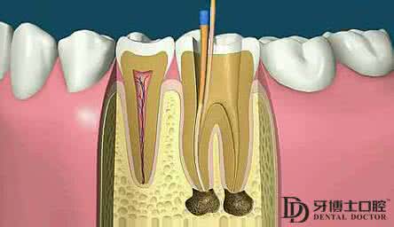 根管治疗第二次做什么 根管治疗第二次做什么？
