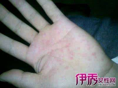 阴囊湿疹皮肤变黑 阴囊湿疹皮肤变黑 阴囊皮肤发黑是怎么回事呢
