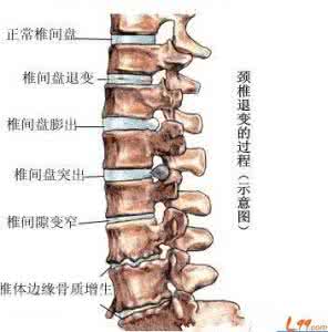 正骨按摩能冶椎间盘吗 椎间盘是怎样形成的
