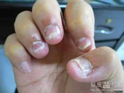 治疗灰指甲的验方 红霉素治疗灰指甲验方！