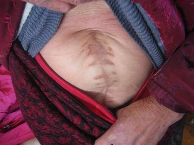 肿瘤和癌症的区别 癌症的早期症状 肿瘤癌症的早期症状及自我检查