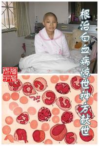 白血病能根治吗 根治白血病，惊世神方献世 