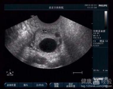 卵泡20x15容易受孕吗 卵泡多大可以受孕