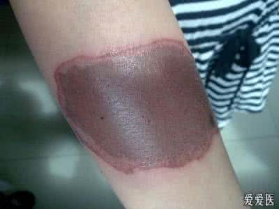 化学性皮肤灼伤 化学性皮肤灼伤 化学性皮肤灼伤是怎么回事