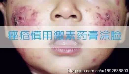 泰国蛇毒面膜有激素吗 激素导致肥胖怎么办 “毒面膜”导致你患上了激素脸
