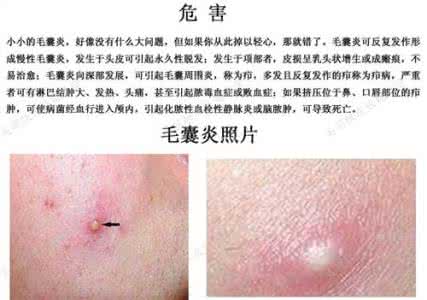 背部痤疮的治疗方法 背部痤疮的治疗方法有哪些