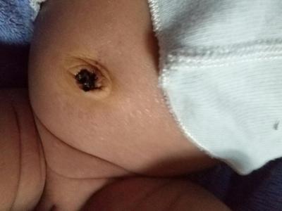 宝宝肚脐消毒 宝宝肚脐掉了怎么消毒?